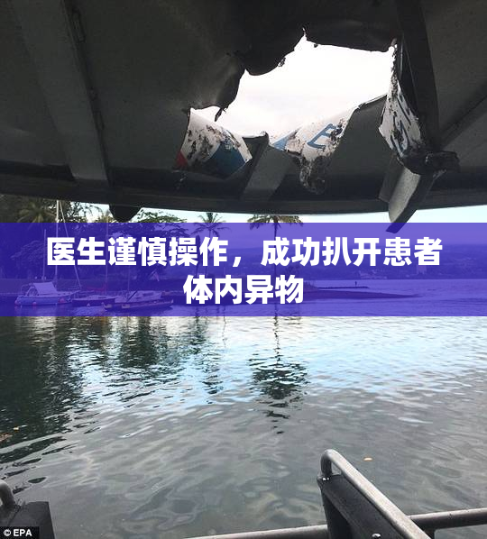 医生谨慎操作，成功扒开患者体内异物